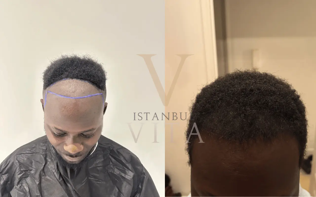 Afro Hair Transplant for Receding Hairline