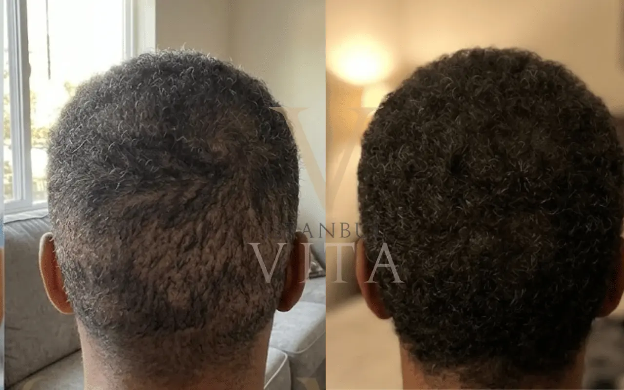 Afro hair transplant for crown thinning