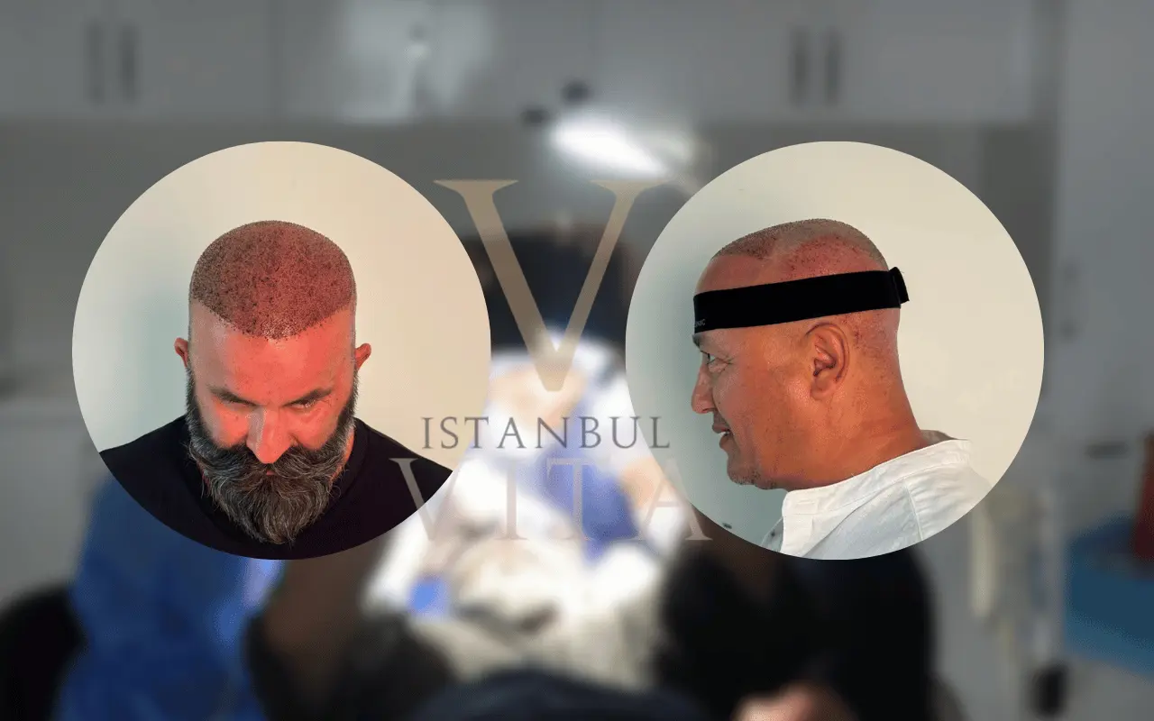 hair transplant results after results