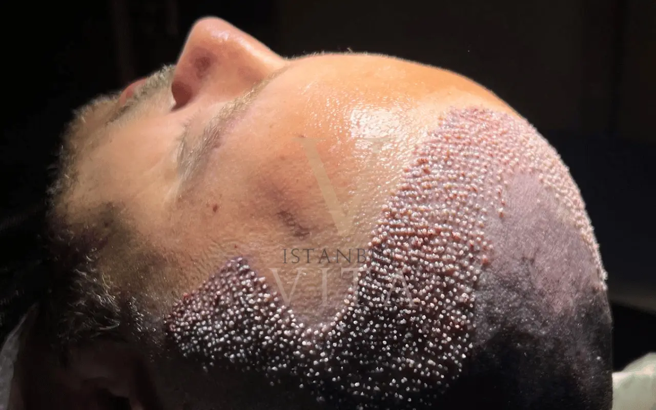 a closeup of hair transplant grafts placement 