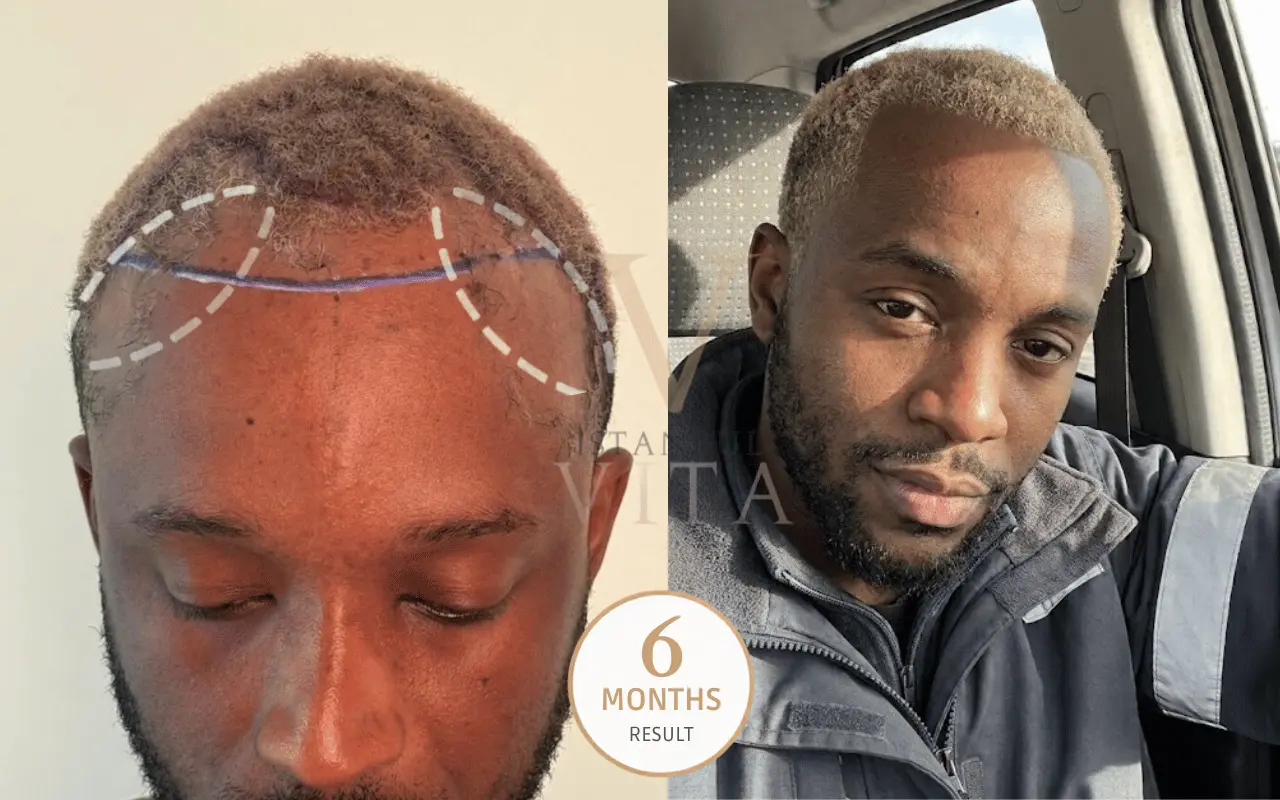 Afro hair transplant for traction alopecia