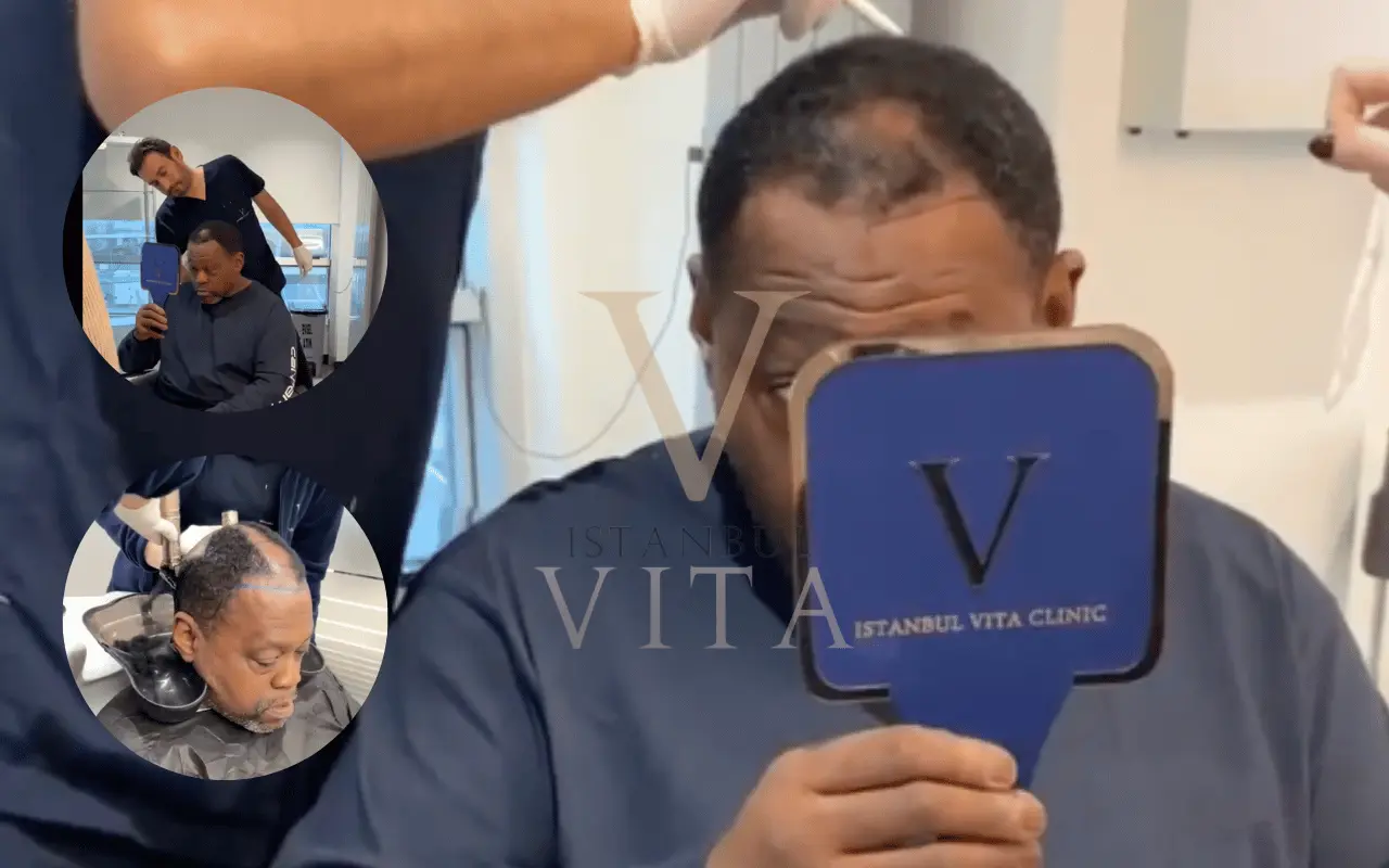 Afro hair transplant consultation