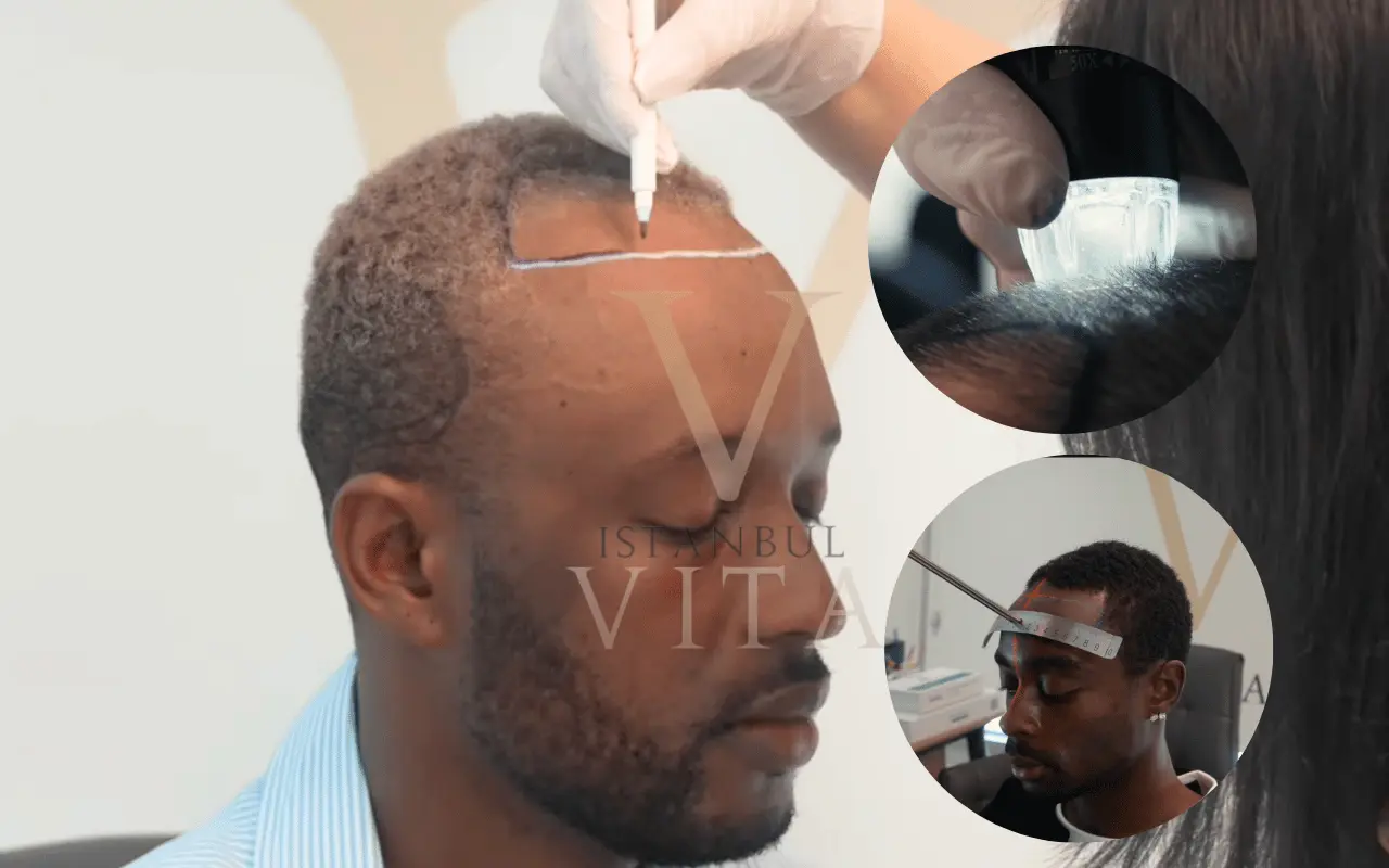 afro hair transplant photos