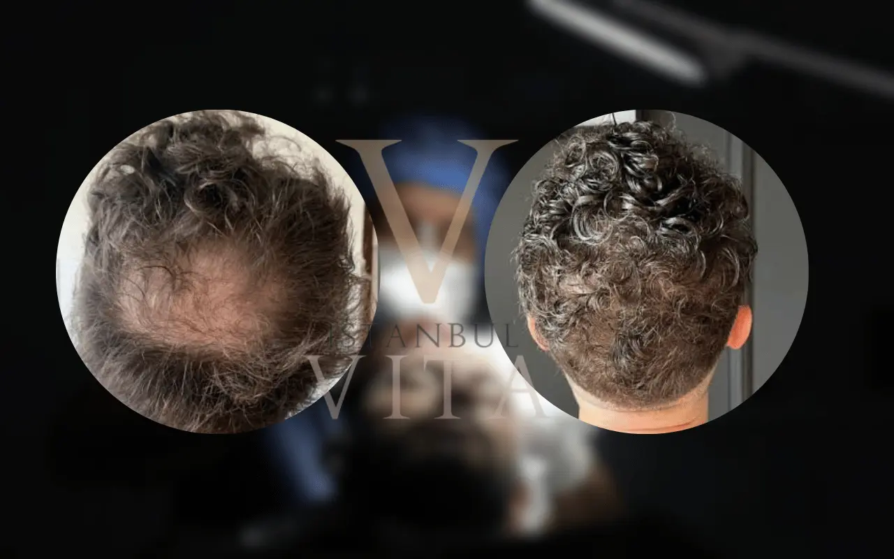 crown hair transplant turkey