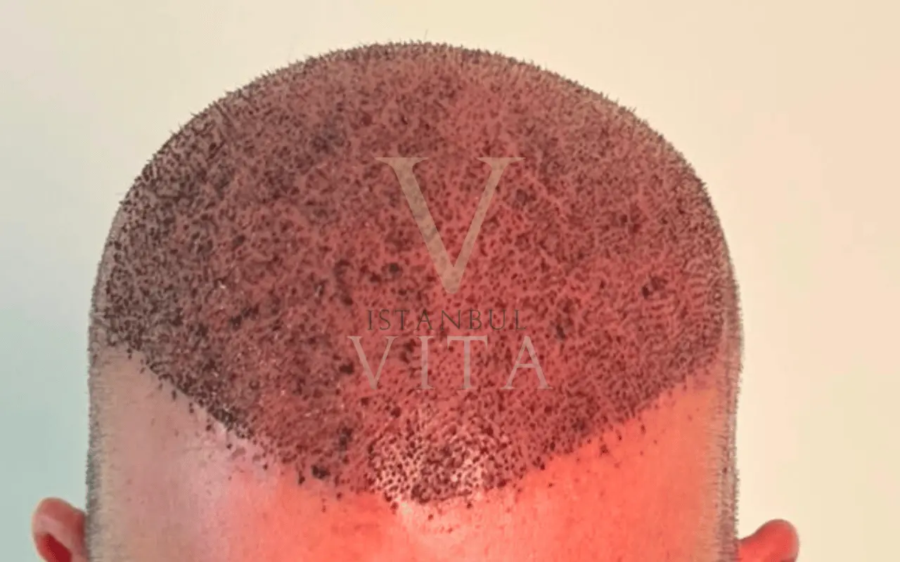 a patient with 5000 graft placement