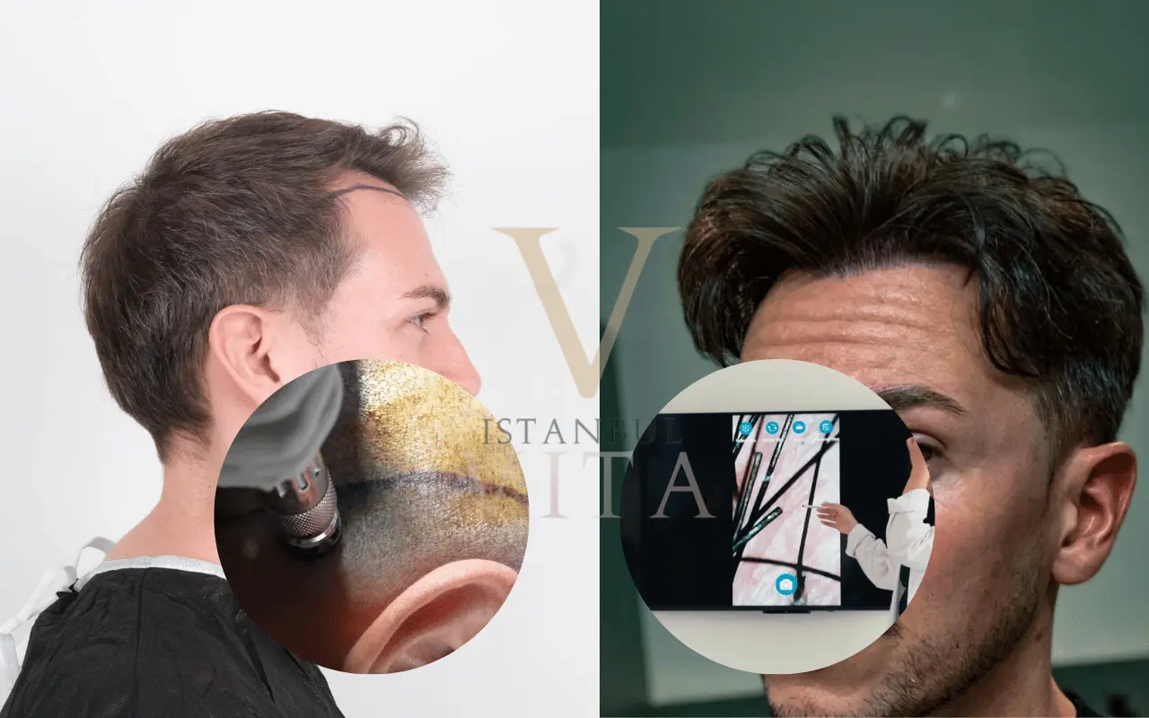 Second Hair Transplant in Turkey