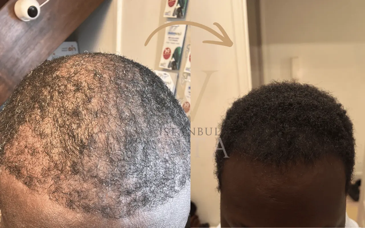 Failed Hair Transplant Repair in Turkey