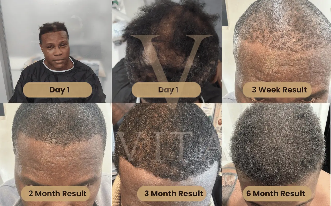 Afro Hair Transplant Results Timeline