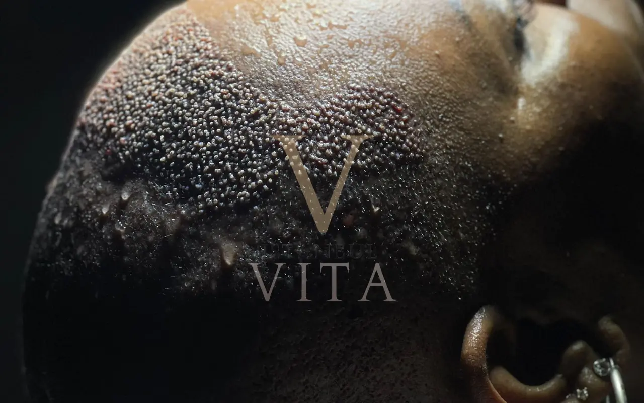 Afro hair transplant Turkey