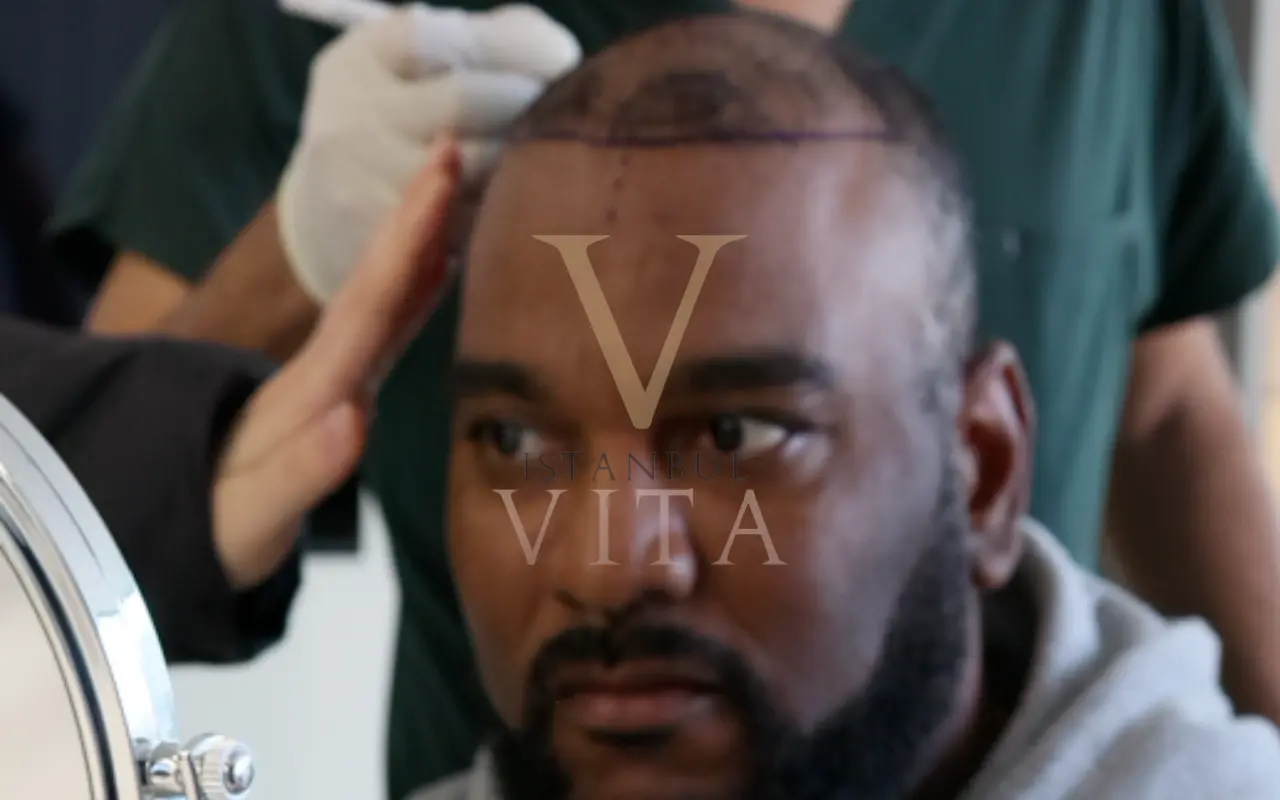 afro hair transplant results