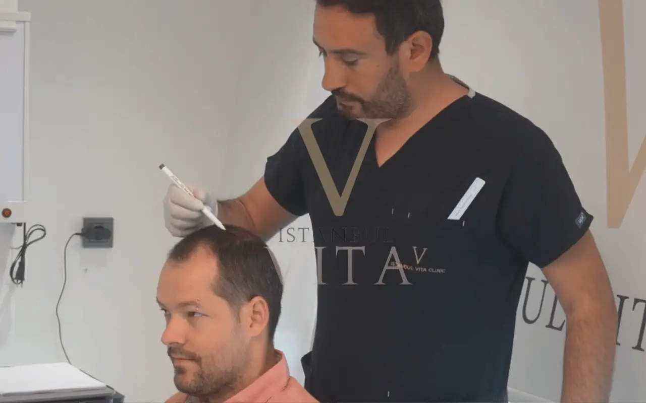 a doctor is checking the scalp of a patient for hair transplant