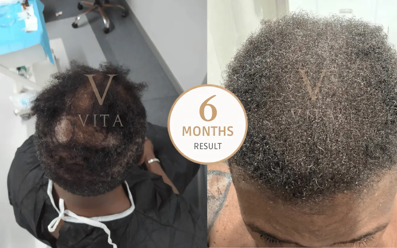 afro hair transplant clinic