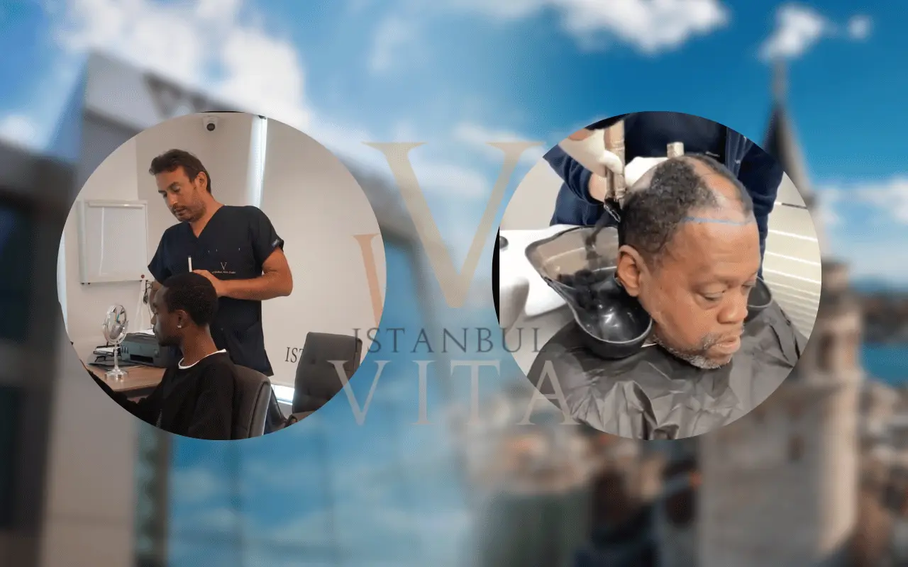 The best afro hair transplant clinic in Istanbul