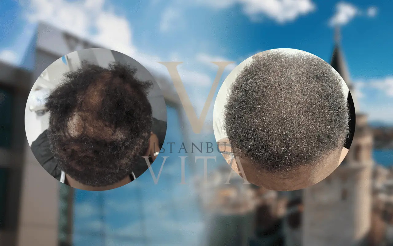 afro hair transplant Turkey