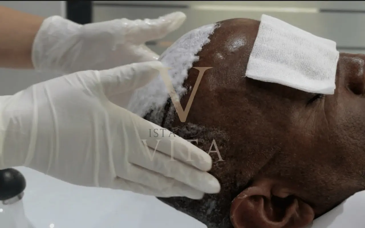 Washing after black hair transplant
