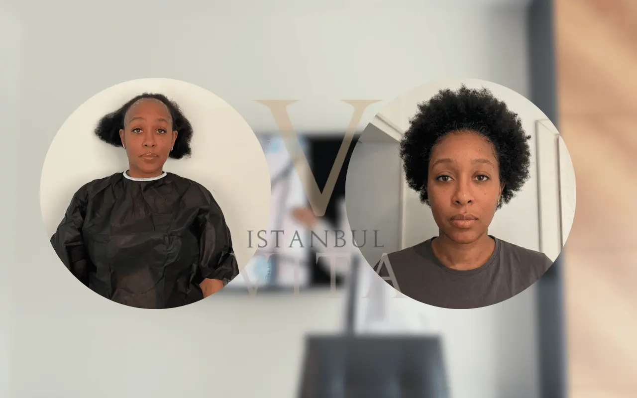 hair growth after black hair transplant