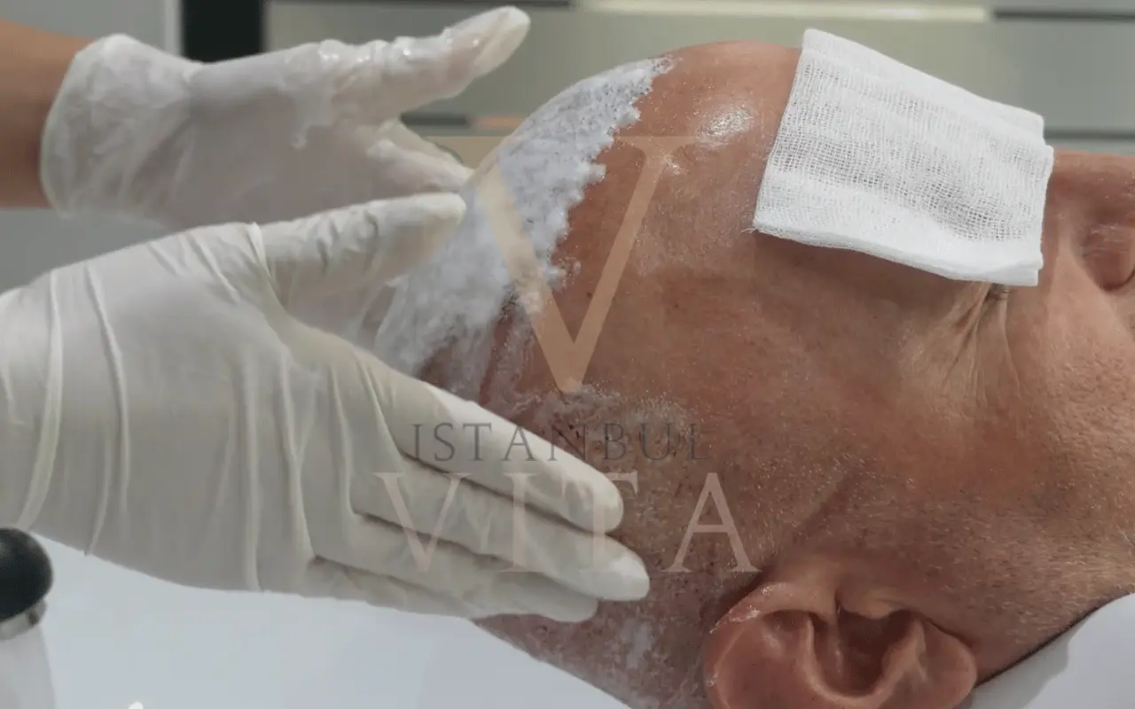 dr is washing hair after hair transplant