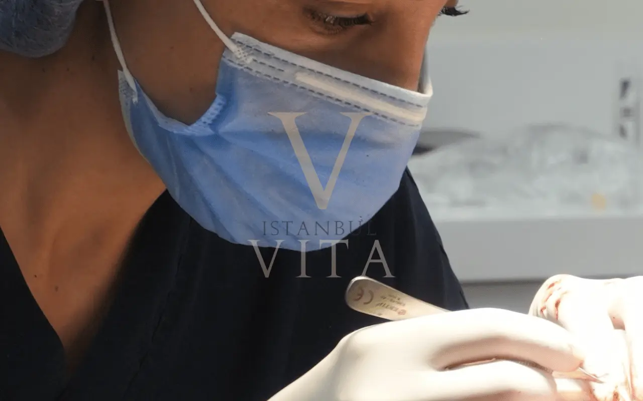 a dr is doing hair transplant by picking and placing the grafts