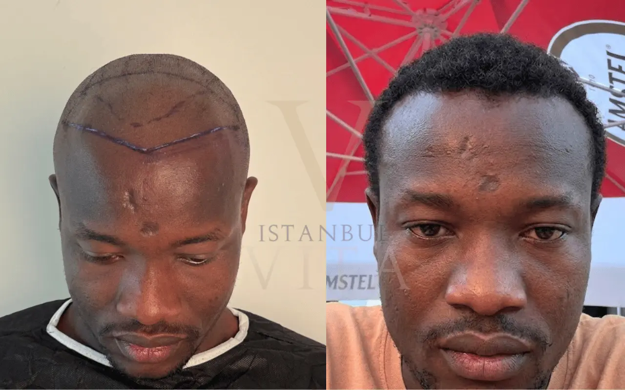 Mature Hairline in Black Men