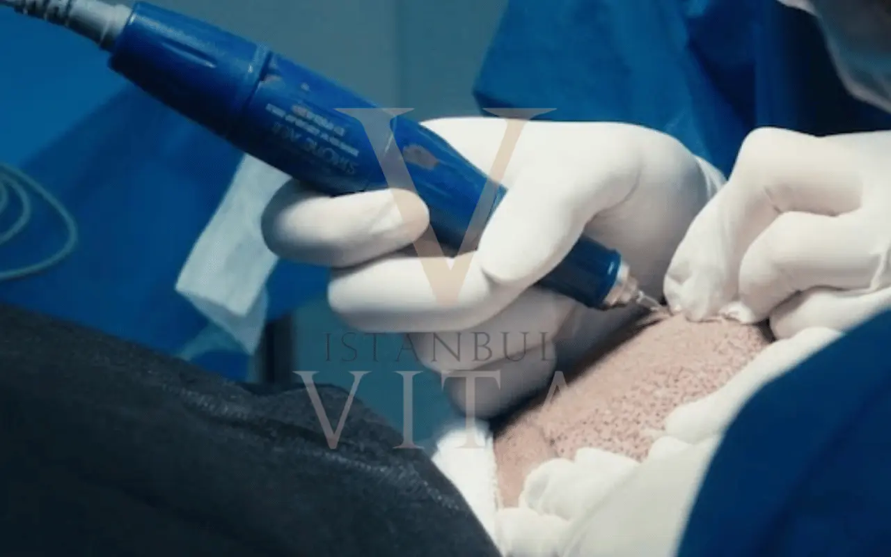 a dr while doinmg hair transplant