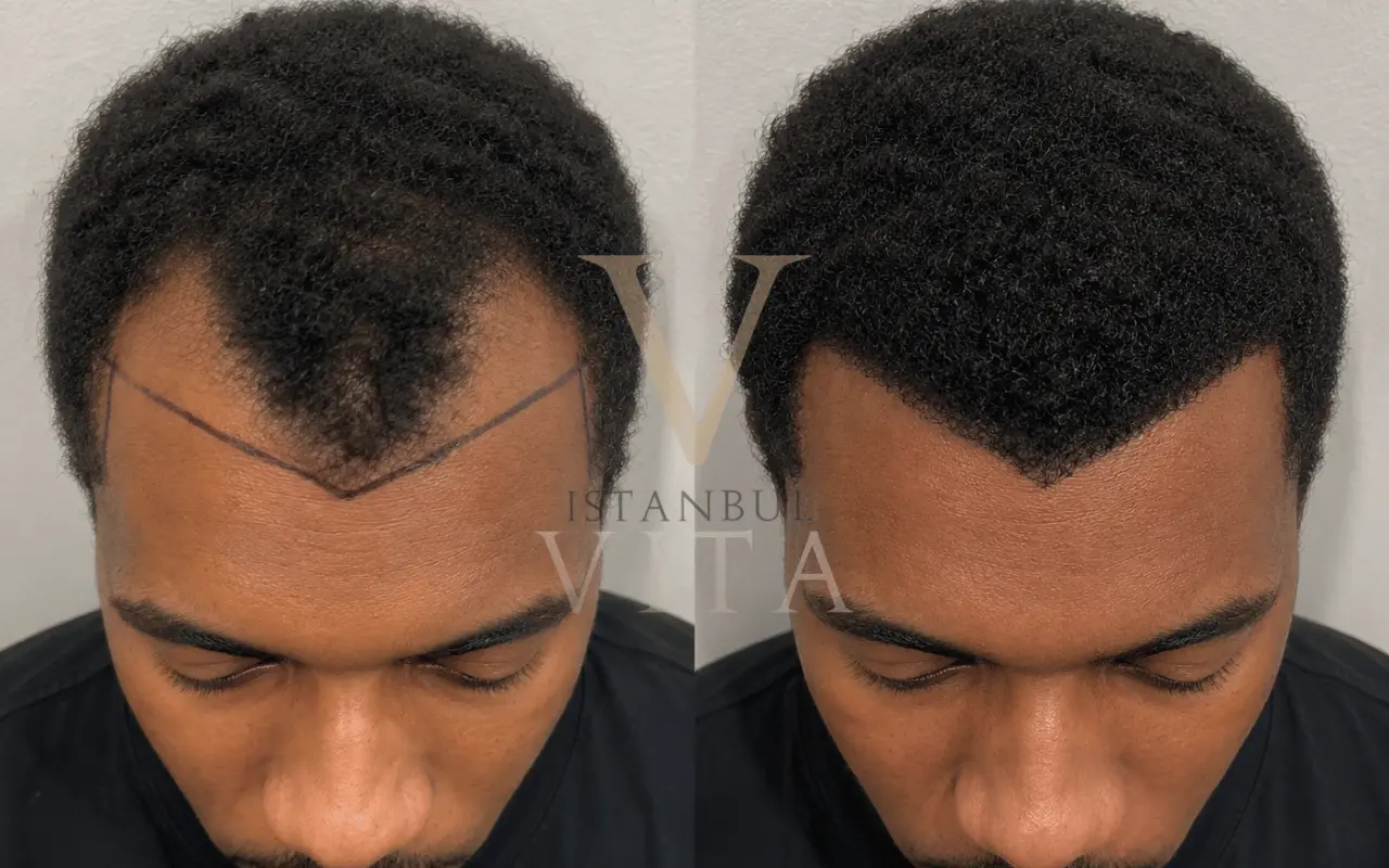 Create V-Shaped Hairline