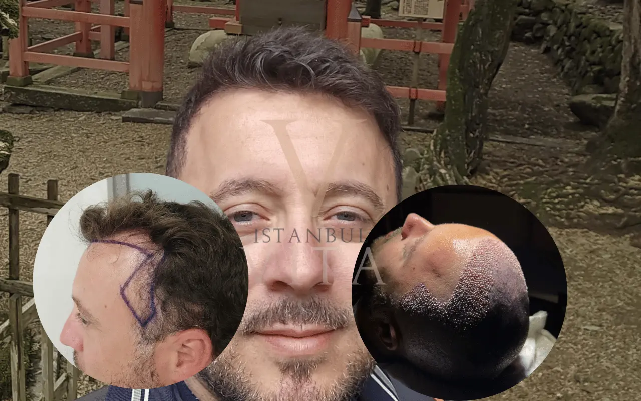 Widow's Peak Hair Transplant