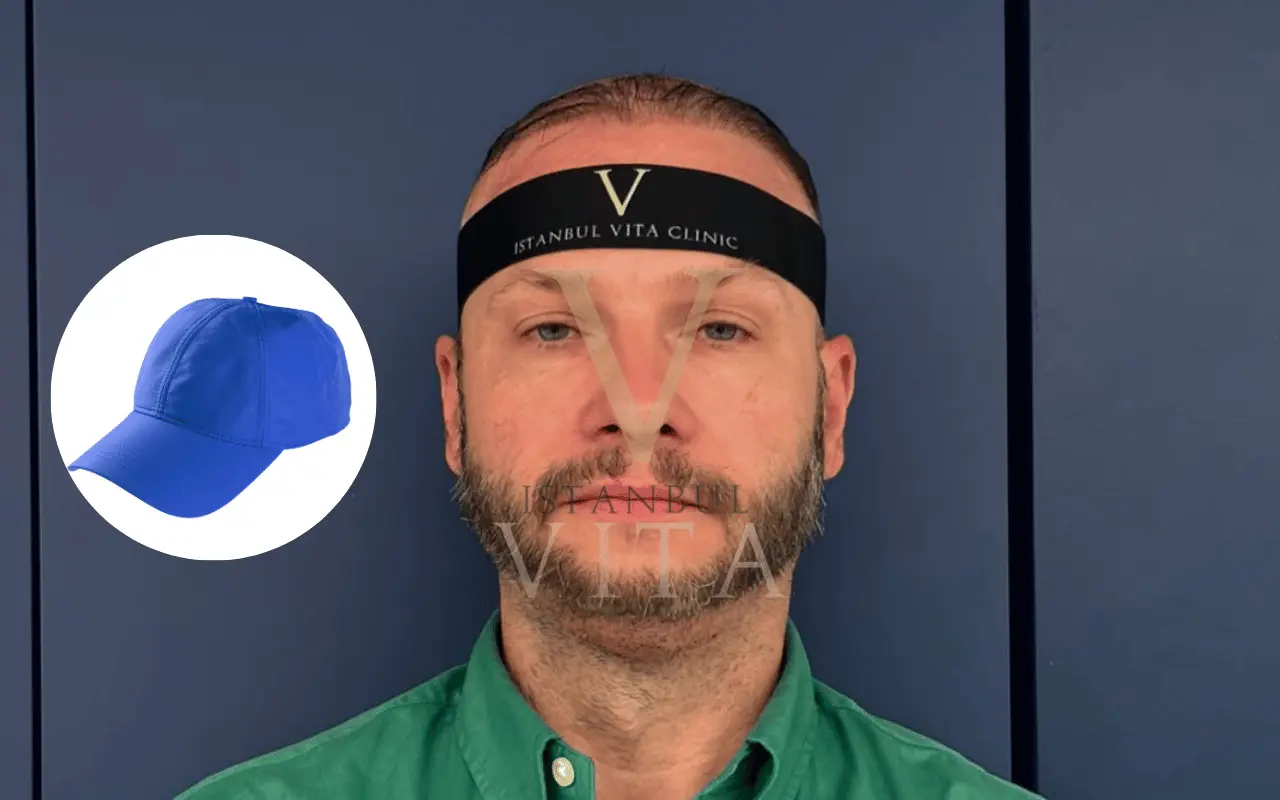 Can I Wear a Hat After Hair Transplant