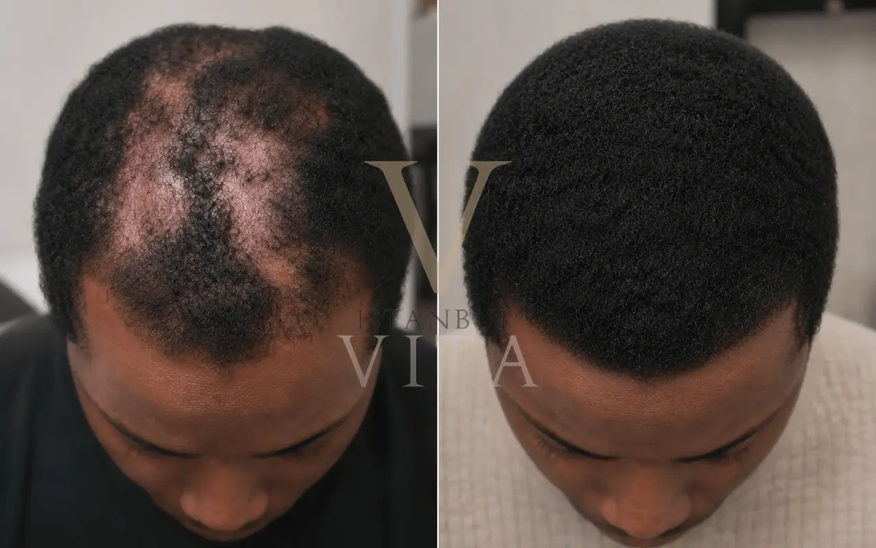 Afro Hair Transplant for Scarring Alopecia