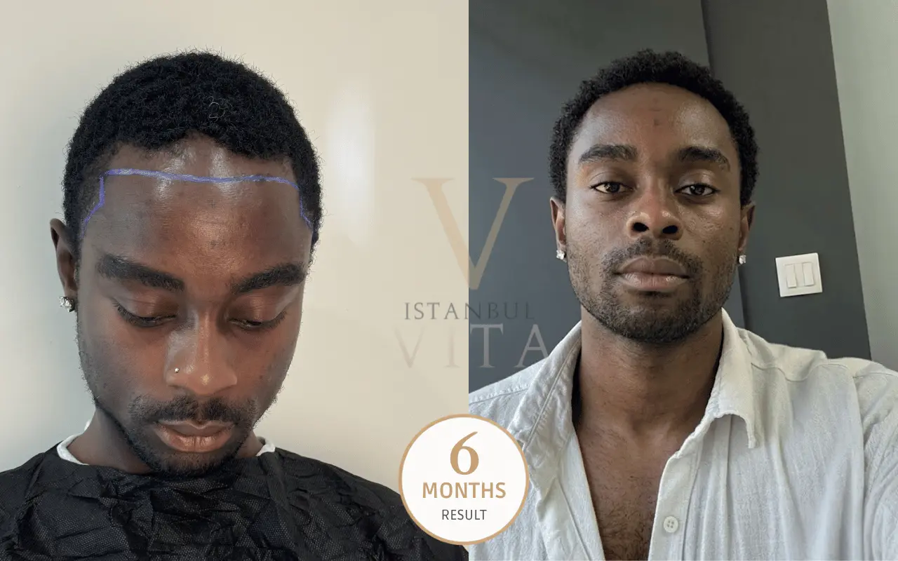 afro hair transplant before and after results
