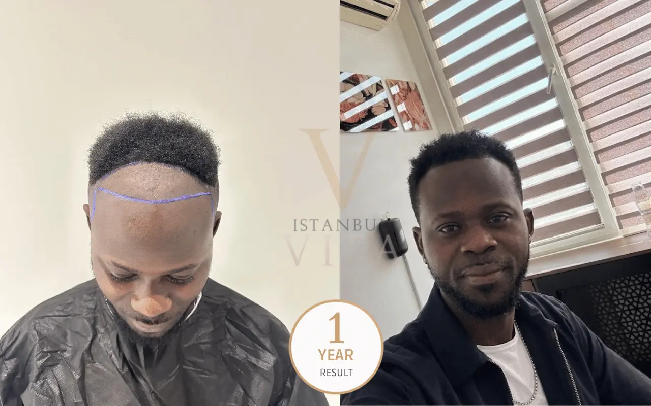 afro hair transplant results