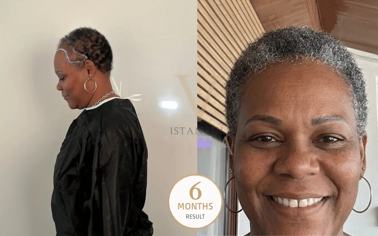 female afro hair transplant