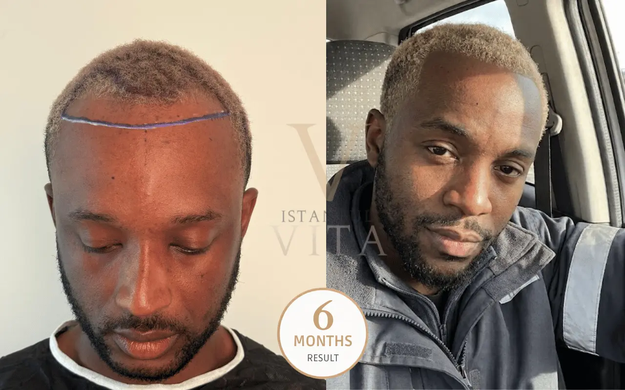 Before and after Afro hair transplant in Turkey