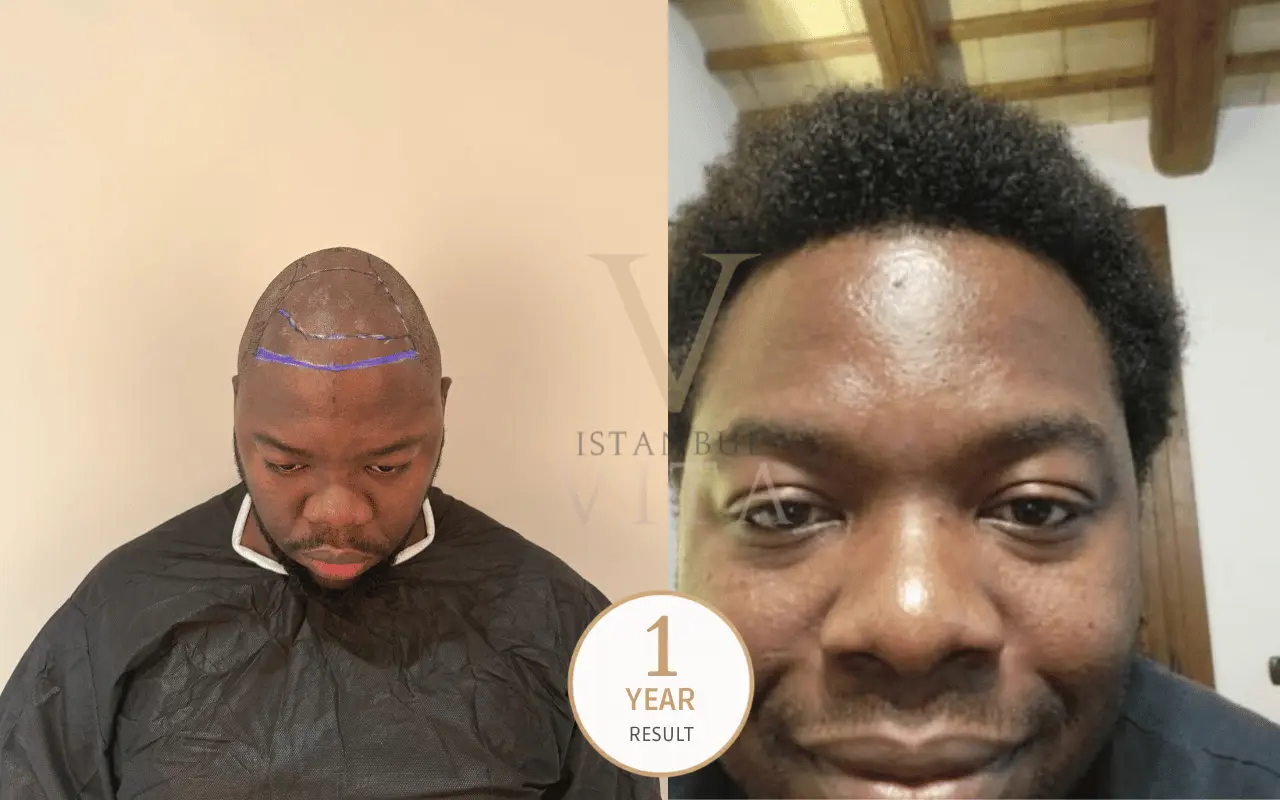 afro-textured hair transplant