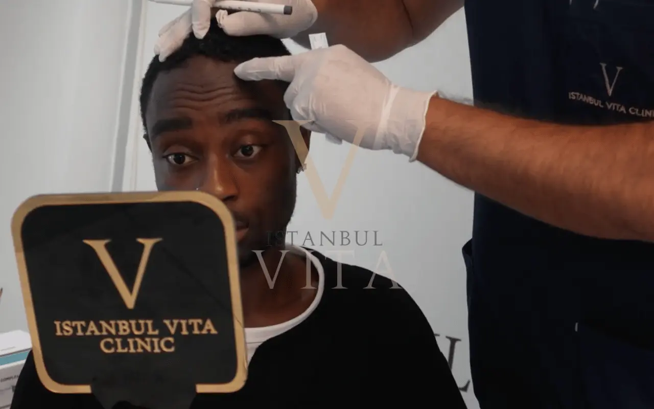 doctor led afro hair transplant procedure in Turkey