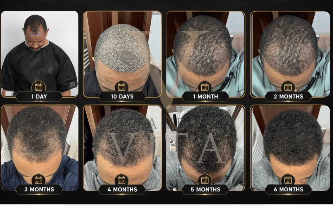 afro hair transplant in turkey before and after timeline