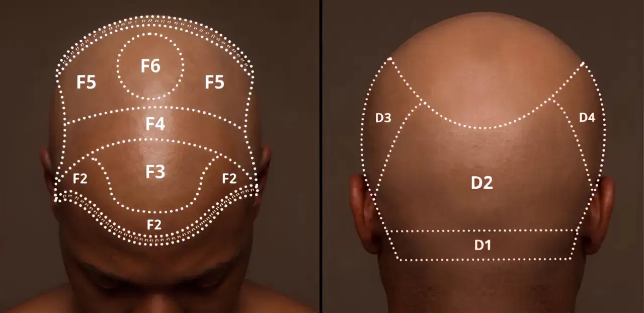 afro hair transplant donor area analysis