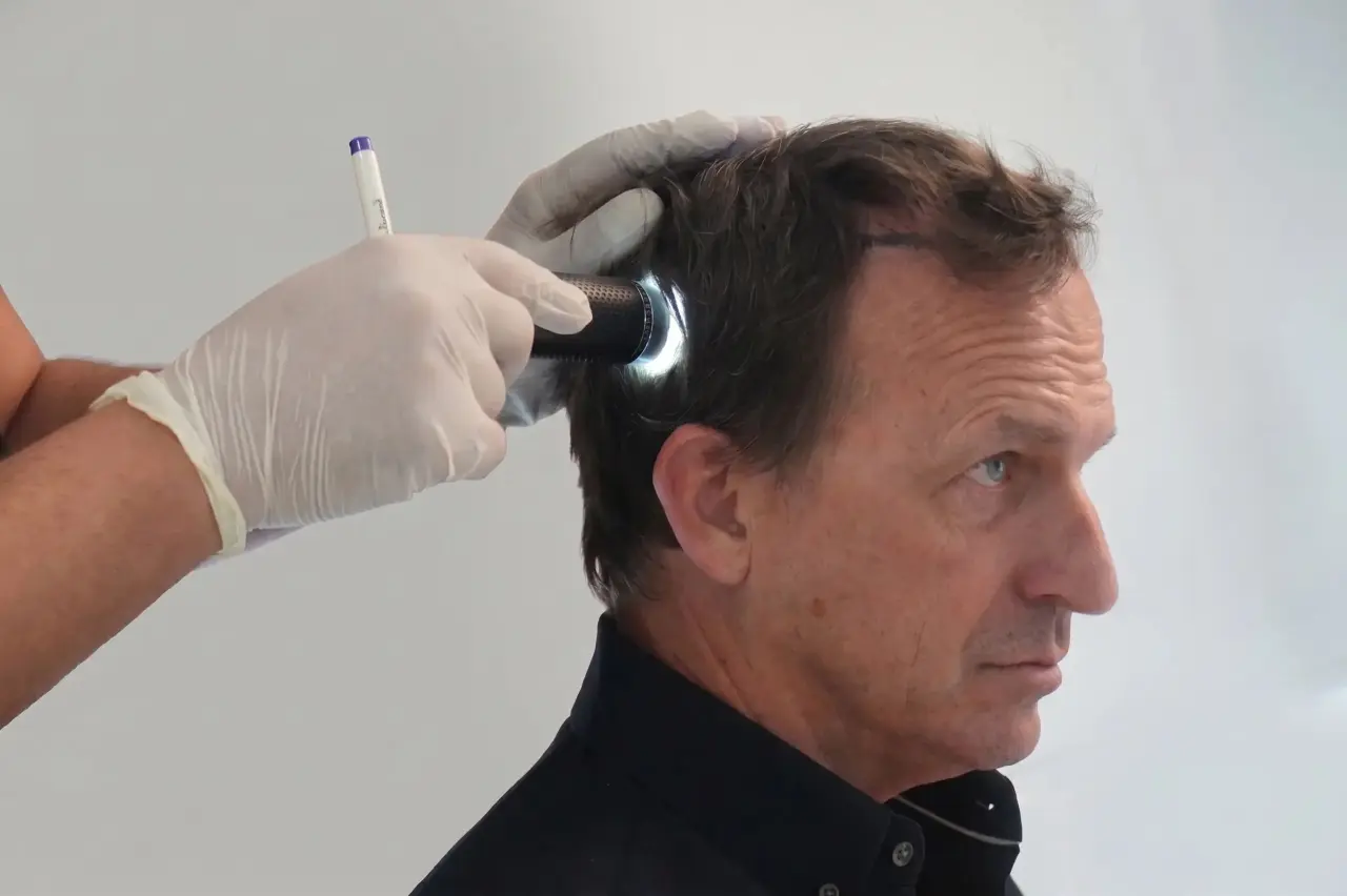 Donor area assessment before determining hair transplant graft count