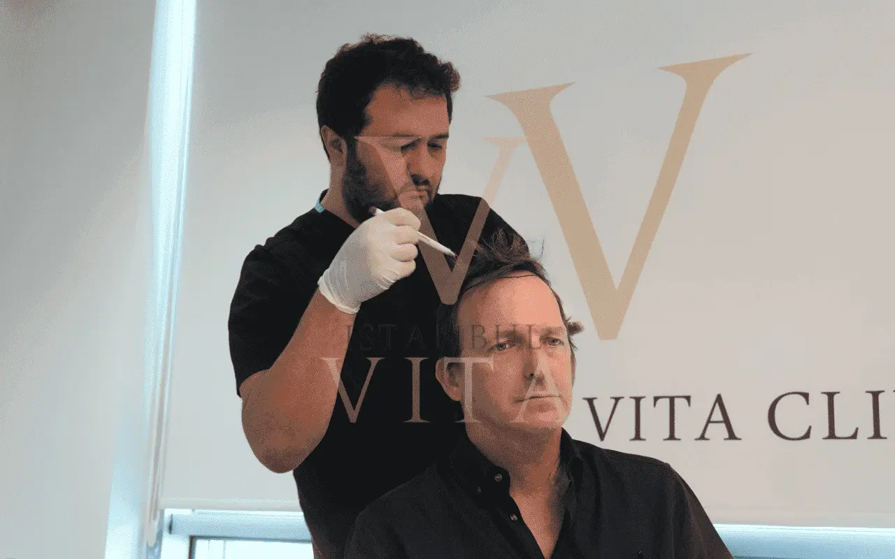 Haartransplantation Beratung türkei 2026 istanbul vita
