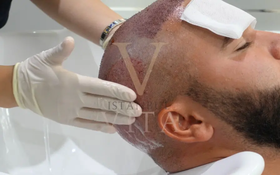 cleaning the donor area after hair transplant in turkey