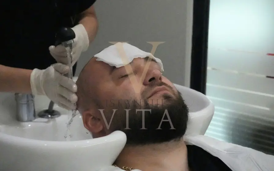 how to wash hair after a hair transplant rinsing hair