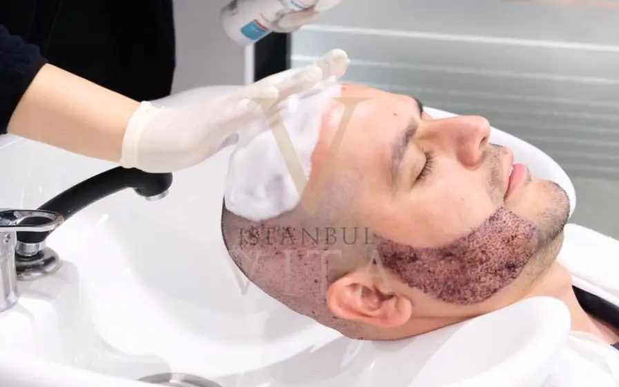 applying foam after hair transplant 2026