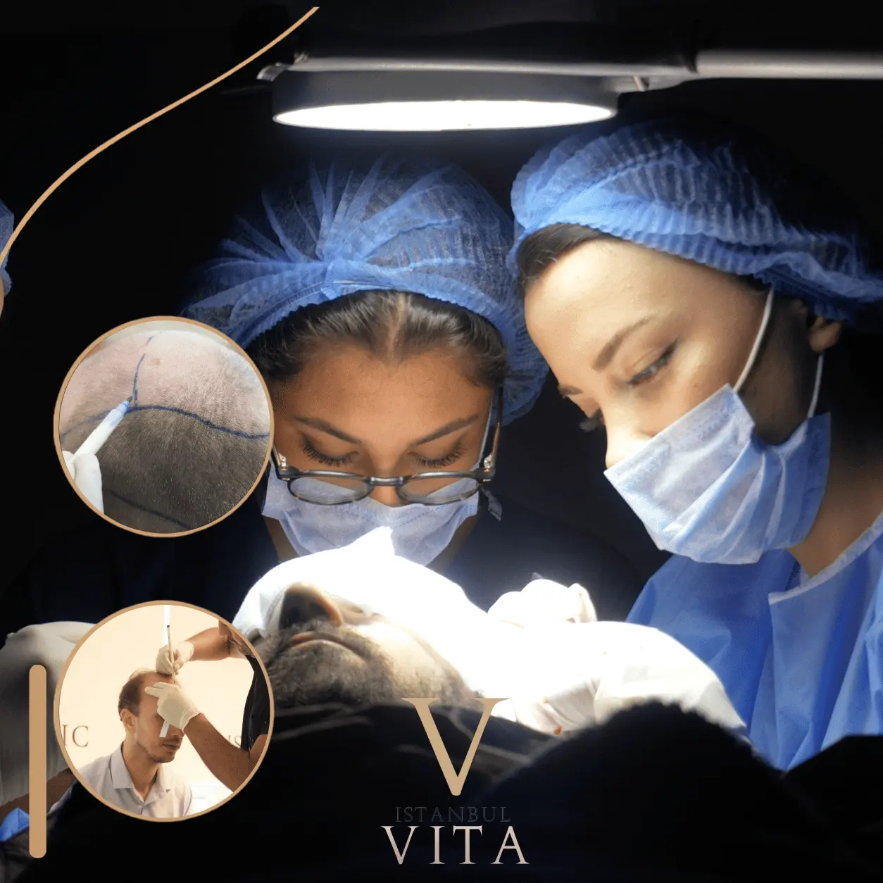 TDF hair transplant planning and procedure at Istanbul Vita
