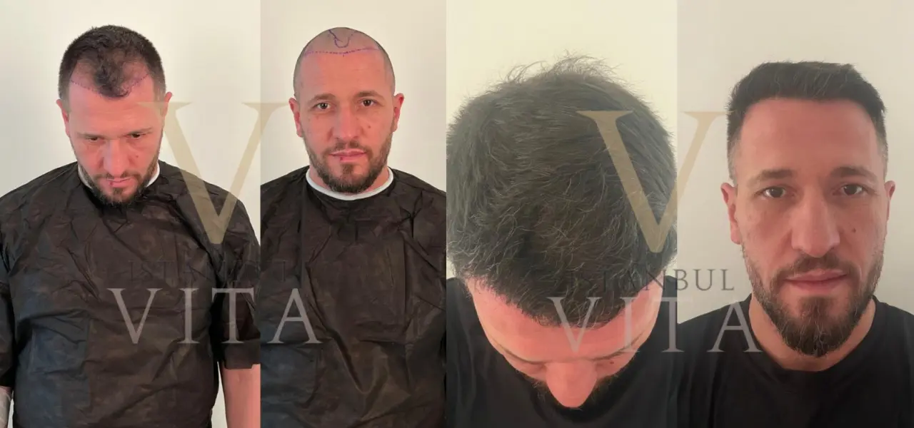 hair transplant turkey before after