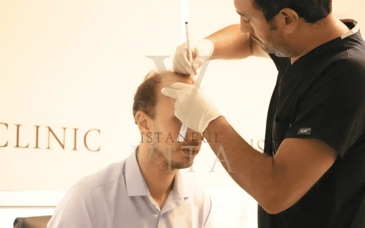 Pianificazione dell'attaccatura prima del trapianto di capelli TDF presso Istanbul Vita