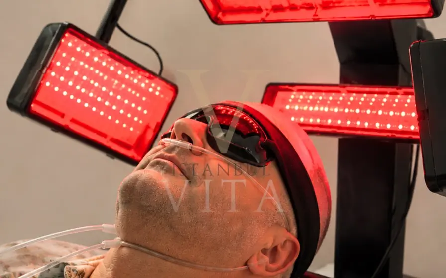 Laserterapia Dopo il Trapianto di Capelli: Luce Rossa (LLLT) 2026 istanbul vita