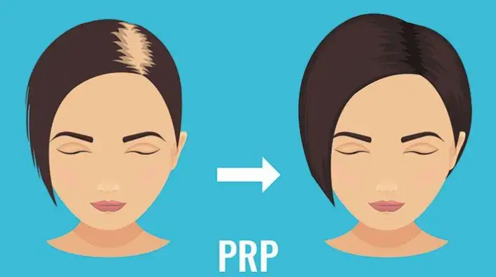 What is PRP Hair Treatment? | Process Steps and cost in 2024