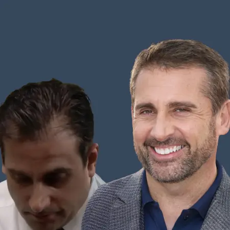 Steve Carell Before and After Hair Transplant