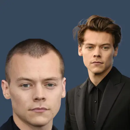 Harry Styles Before and After Hair Transplant
