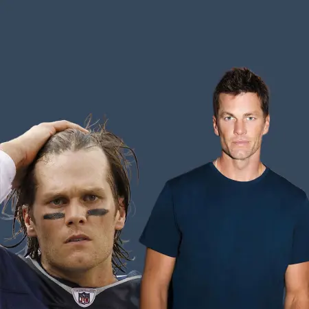 Tom Brady Before And After Hair Transplant