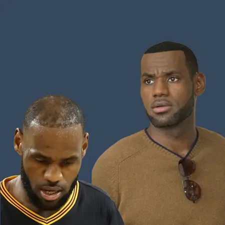 LeBron James Before and After Hair Transplant